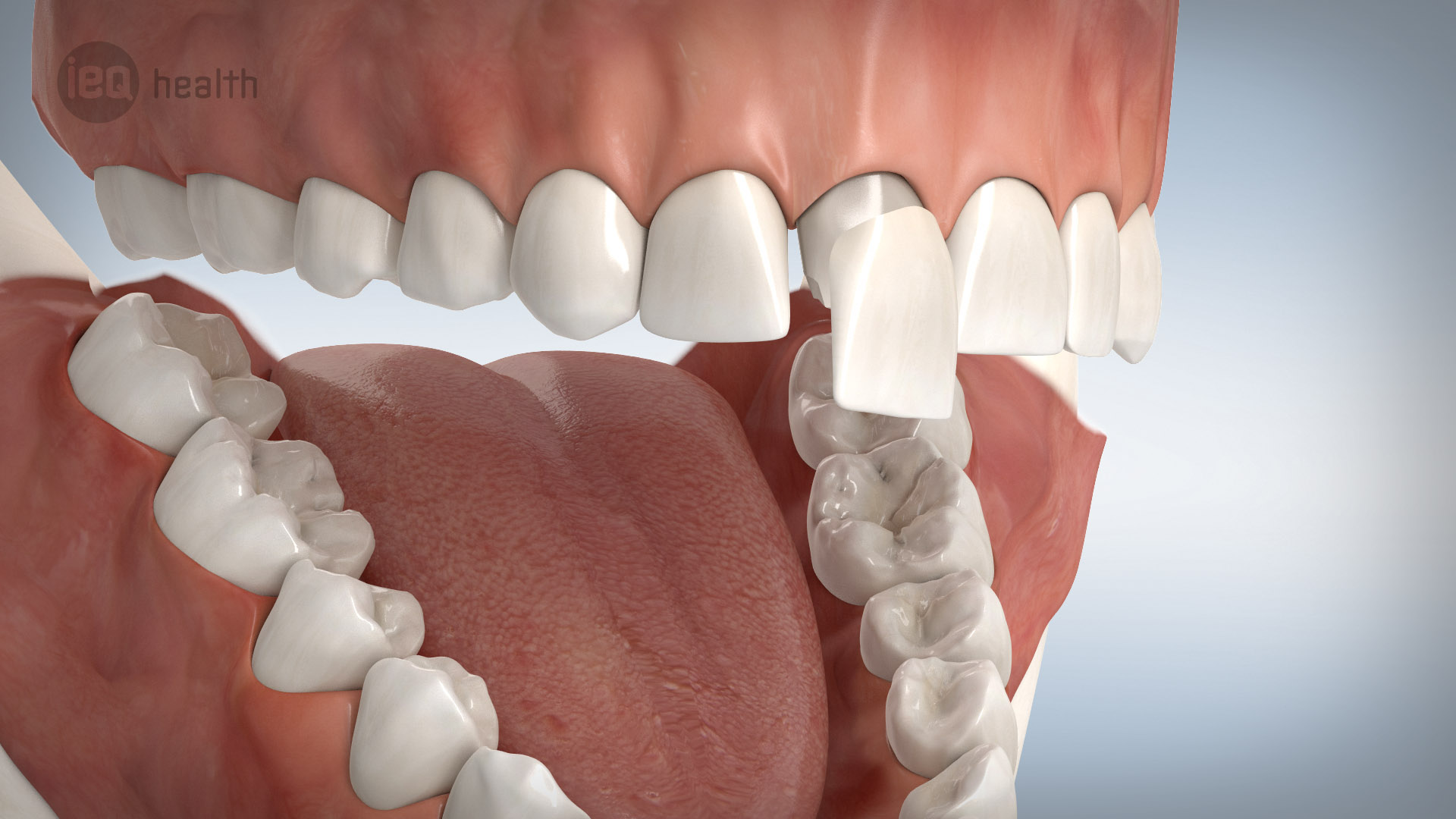 Veneers In Dusseldorf Keramikverblendschalen Fur Frontzahne